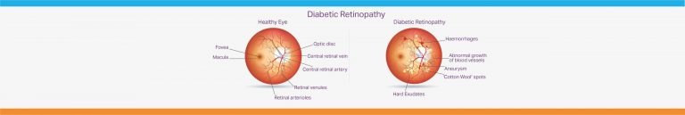 A labelled diagram showing two cross sections of an eye to illustrate diabetic retinopathy.