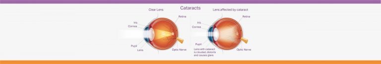 A diagram showing two cross sections of an eye, one with and one without a cataract.